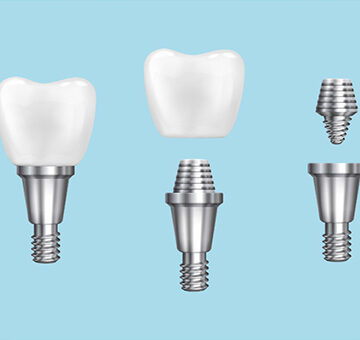 Can Dental Implants Be Done in One Day?