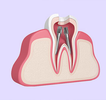 How Exactly Is a Root Canal Done? How Long Does Root Canal Treatment Take?