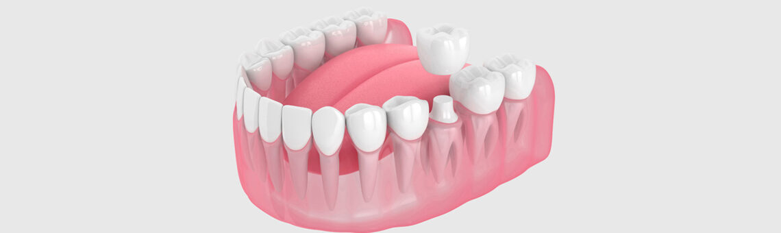 What Causes Dental Crown Pain and How to Manage Discomfort?