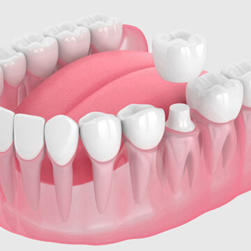 What Causes Dental Crown Pain and How to Manage Discomfort?