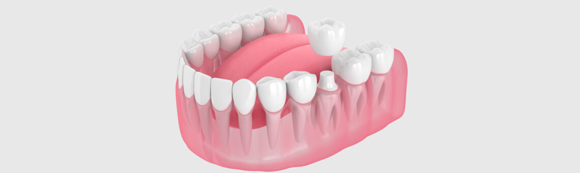 What is the Durability of Dental Veneers with Adequate Maintenance?