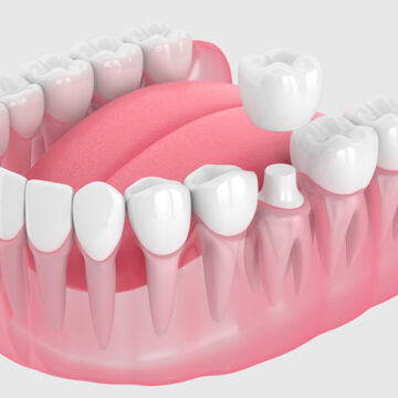 What is the Durability of Dental Veneers with Adequate Maintenance?