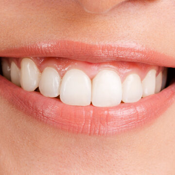Considering a Smile Makeover? Here’s Why Veneers Are Your Best Option!