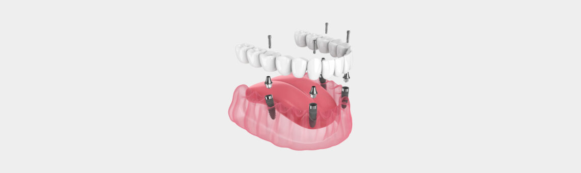 Implant Supported Dentures Offer a Stable Remedy for Missing Teeth