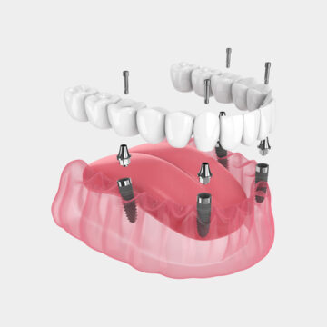 Implant Supported Dentures Offer a Stable Remedy for Missing Teeth