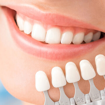 The Caro Smile Makeover: How Veneers Can Completely Transform Your Look in Just Two Visits?